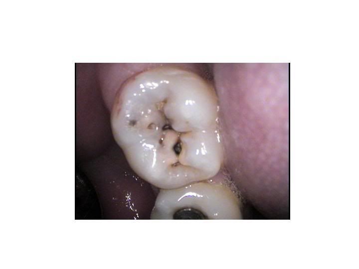 small cavity tooth